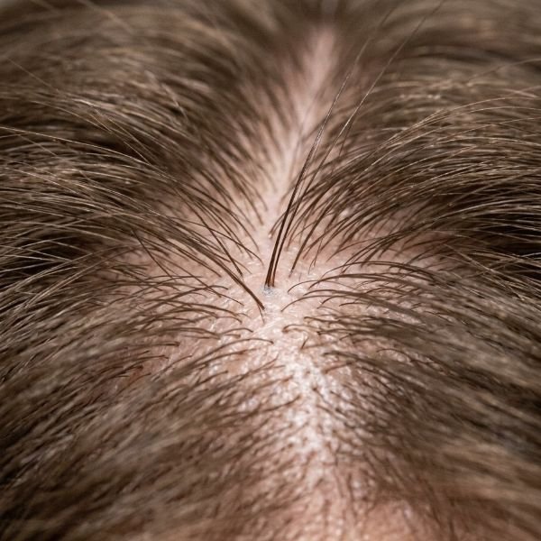 Repeat scalp visibility